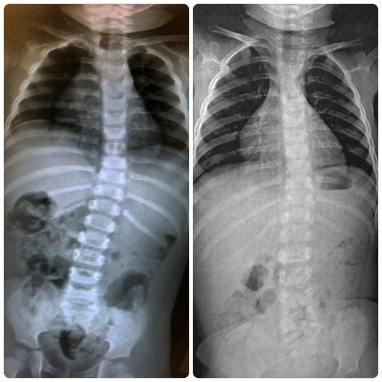 Before and after spine x-rays of a toddler treated by Dr. Amato